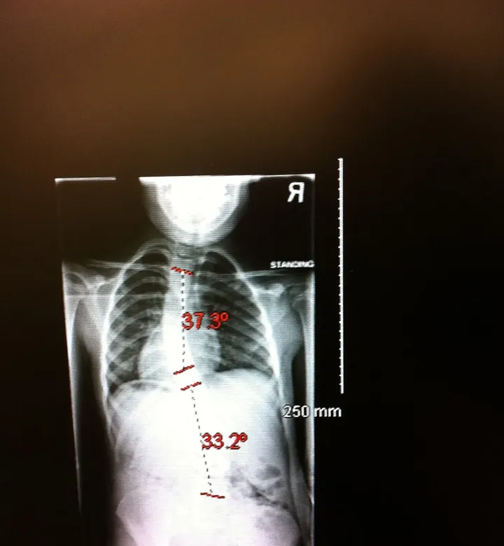 Radiografia da coluna de uma criança com escoliose e os ângulos medidos