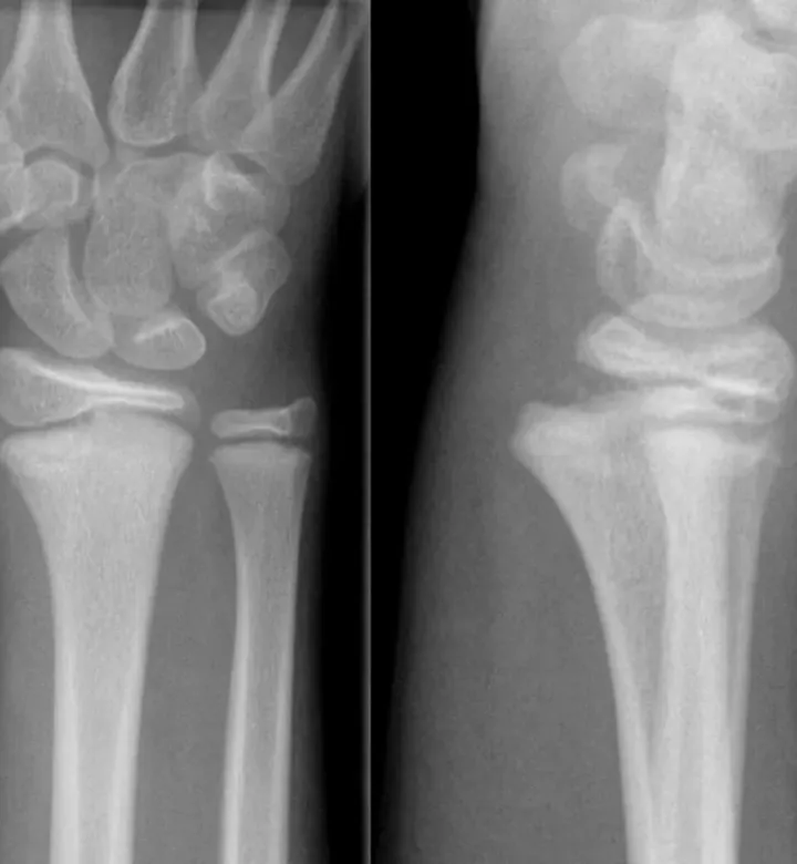 Radiografia de fratura do punho em um menino de 12 anos