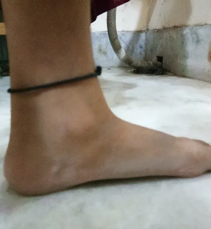 Pé de criança com o arco plantar baixo, típico do pé plano