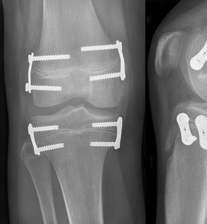 Radiografia do joelho de um adolescente com placas de crescimento guiado